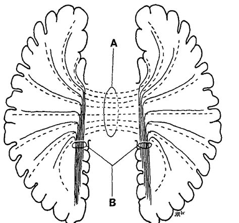 A. Commissural fibers in normal brain are shown by dashed lines. B ...