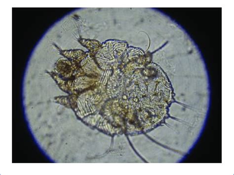 Warren L Microscopic Section Of Sarcoptes Scabiei Mite Showing Eight