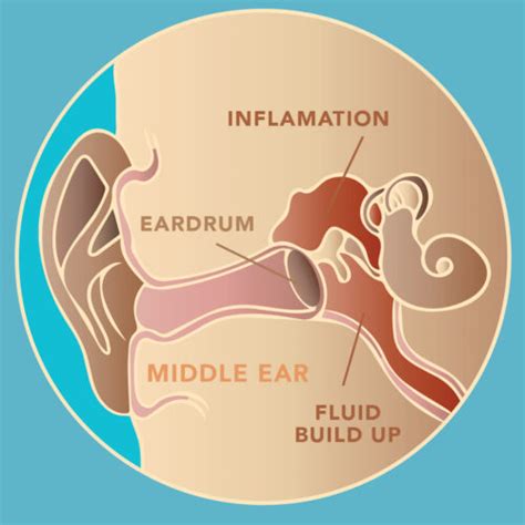 Visualizing Acute Otitis Media With Non Invasive Otosight Technology