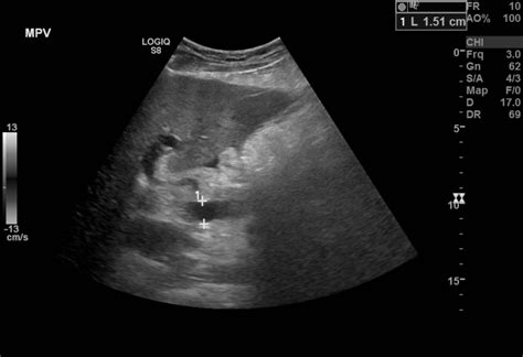 [figure B Mode Ultrasound Showing Main Portal ] Statpearls Ncbi