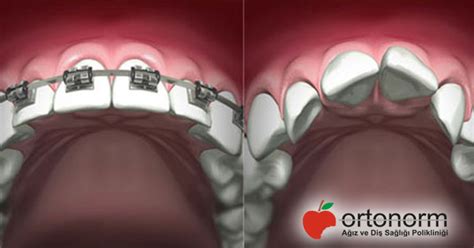 Ortodonti Uzmanlığı Nedir