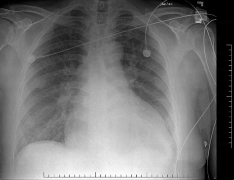 Congestive Heart Failure And Acute Pulmonary Edema Cardiovascular