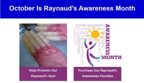 Raynaud S Video Archives Raynaud S Association