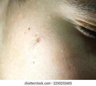 5 Skin Hamartoma Images, Stock Photos & Vectors | Shutterstock