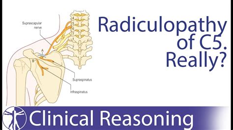 Suprascapular Nerve Entrapment Mimicking C Radiculopathy Youtube | Hot ...