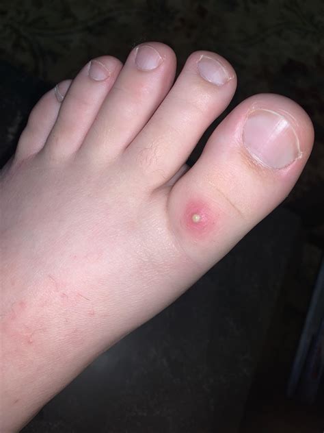 Now that’s a zit. : r/popping