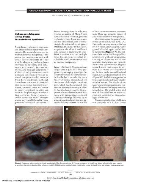 Sebaceous Adenoma of the Eyelid in Muir-Torre Syndrome - DocsLib