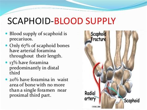 Avascular Necrosis Of Scaphoid