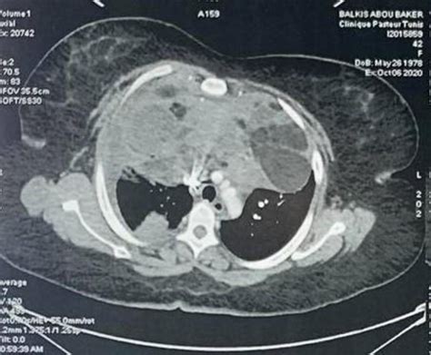 A giant and heterogeneous mass in the right anterior mediastinum with ...