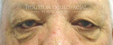 Houston Ectropion Repair Before And After Photos Baytown Plastic