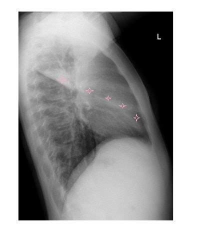 Imaging Case Of The Week 336 Answer Emergucate