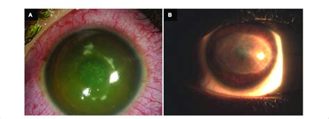 Infectious Keratitis Following Epithelium Off Corneal Cross Linking For