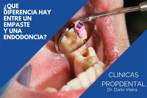 Qué diferencia hay entre un empaste y una endodoncia