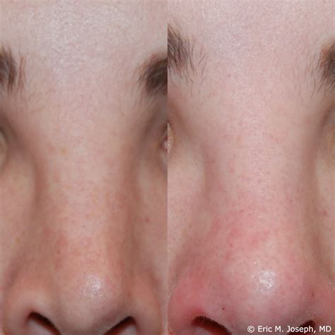 Eric M Joseph Md Permanent Non Surgical Rhinoplasty Nose Job