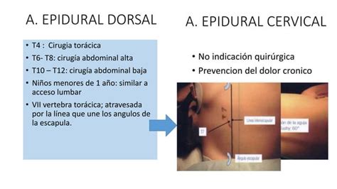 Anestesia Neuroaxial En Pediatria Ppt