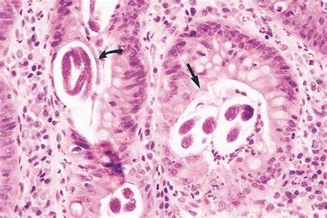 Streptococcus Bovis Bacteremia Associated With Strongyloides Stercoralis Colitis