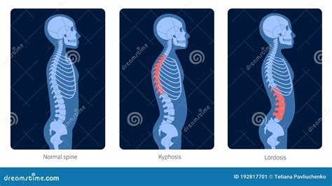 Raggi X Spinosi Illustrazione Vettoriale Illustrazione Di Anatomia