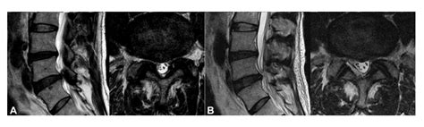 Full-Endoscopic Interlaminar Approach for Decompression of Lateral ...