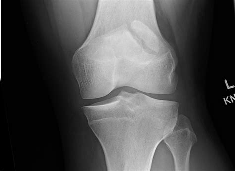 Orthodx Painful Patella Following Fall Clinical Advisor