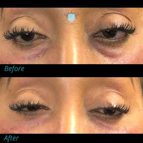 Tear Trough Injections With Dermal Filler