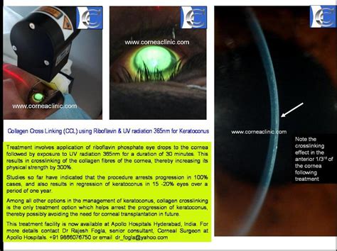 Collagen Crosslinking Using Riboflavin And UVA Exposure For Keratoconus