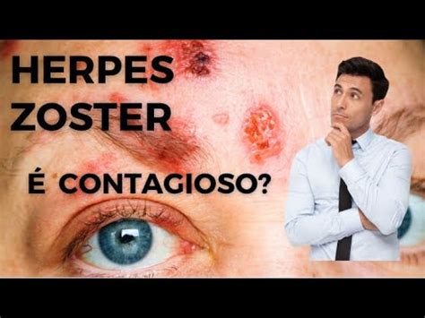 Herpes Zoster Contagioso Por Luiz Gameiro Dermatologista Youtube