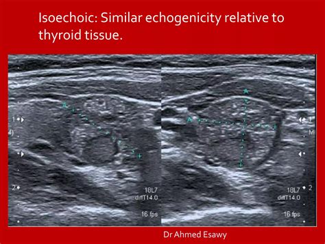 Tirads Thyroid Nodule Imaging Reporting And Data System Dr Ahmed