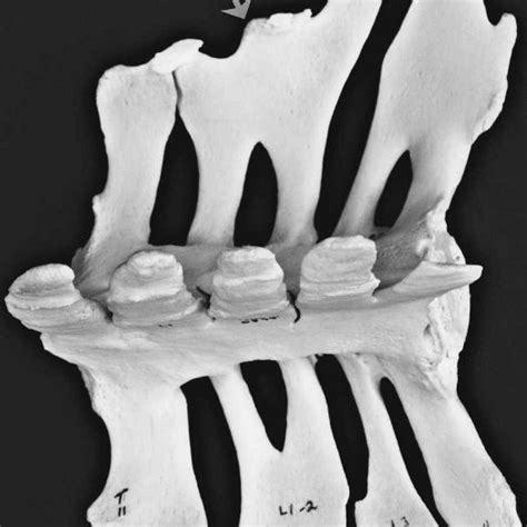 Completely fused cervical vertebrae with fracture of the pedicle of the ...