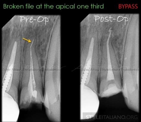 Management Of Broken Files A Clinical Approach Style Italiano Endodontics