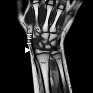 Axial T1W TSE MR Image Of The Wrist M Flexor Carpi Radialis Tendon