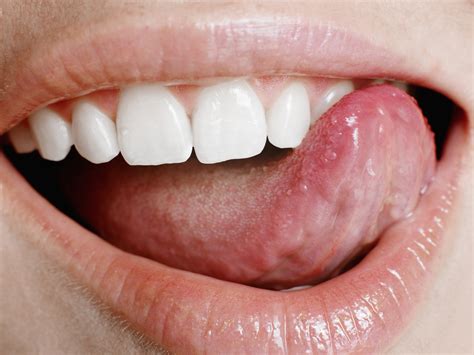 How to Get Rid of Tongue Sores | Healthfully