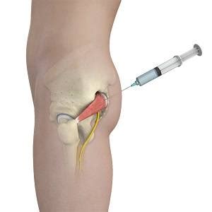 Piriformis Muscle Injection Orange County | Sciatica Pain Laguna Hills CA