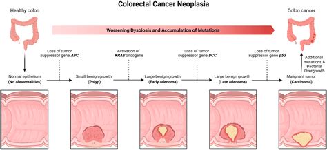 Cancers Free Full Text Bacterial Involvement In Progression And