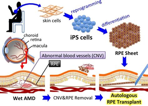 Scheme Describing The Flow Of How Ipscs Are Generated From A Patient S