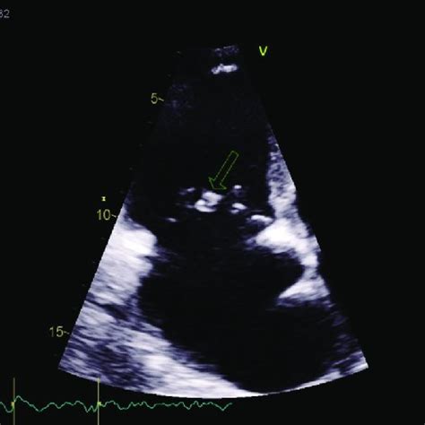 Pulmonic Valve Endocarditis Figure 4 Tricuspid Valve Endocarditis Download Scientific Diagram