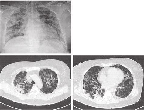 A Chest X Ray And Computed Tomography Scans Transverse Plane Of The