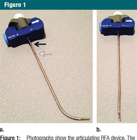 Figure From Treatment Of Metastatic Posterior Vertebral Body Osseous