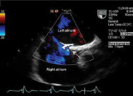 Three Dimensional Transoesophageal Echocardio Graphic View From The