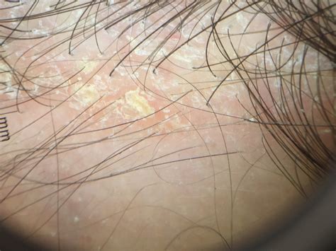 Mild Seborrheic Dermatitis Scalp