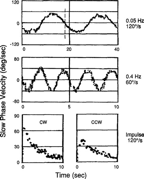 Vestibular Neuritis Clinical‐pathologic Correlation Baloh 1996 Otolaryngology Head And