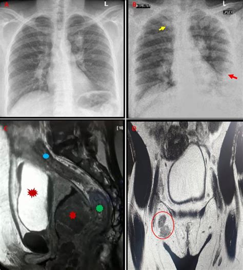 Figure From Malignant Nodular Melanoma Of The Vulva A Rare And