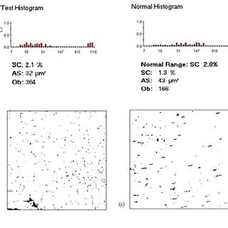 Illustration of test report of clopidogrel resistance in a patient ...