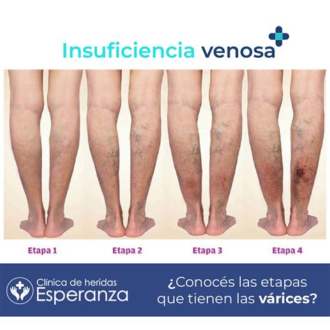Clinica de Heridas Curación de heridas - Clinica de Heridas