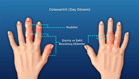 Osteoartrit Kireçlenme Nedir Nedenleri ve Tedavisi Kayhan Turan