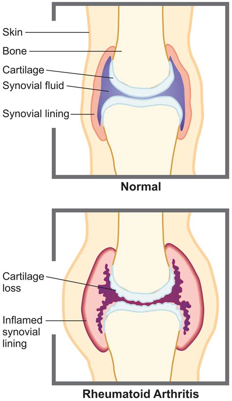 Rheumatoid Arthritis Diagram What Is Rheumatoid Arthritis?