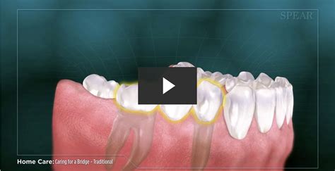 Caring For A Tradtional Tooth Bridge At Home