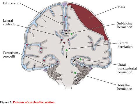 Brain Herniation Types