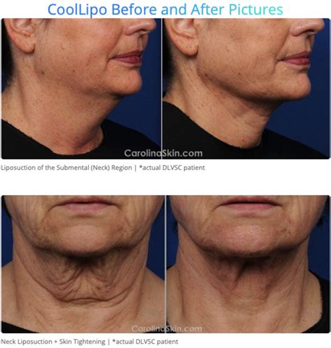 Best Procedure For Neck Tightening Australia Get More Anythink S