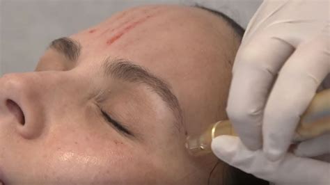 Vampire Facial Microneedling W Prp Between The Before And After Ep