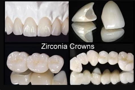 Zirconia crowns are made from zirconium dioxide, a very durable type of ceramic material ...